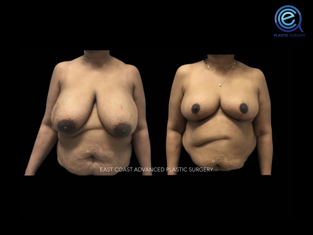 Oncoplastic Breast Reconstruction