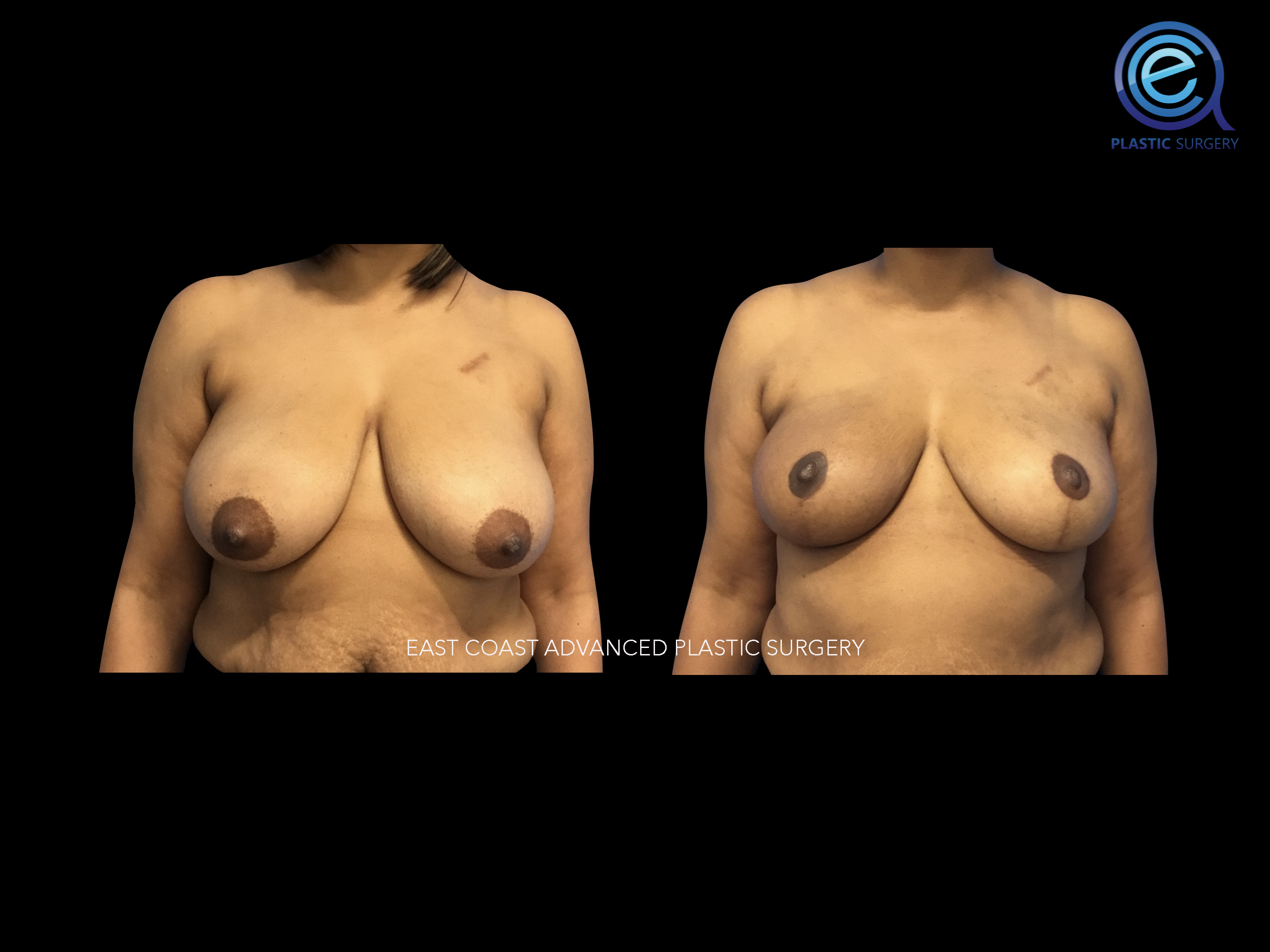 Oncoplastic Breast Reconstruction