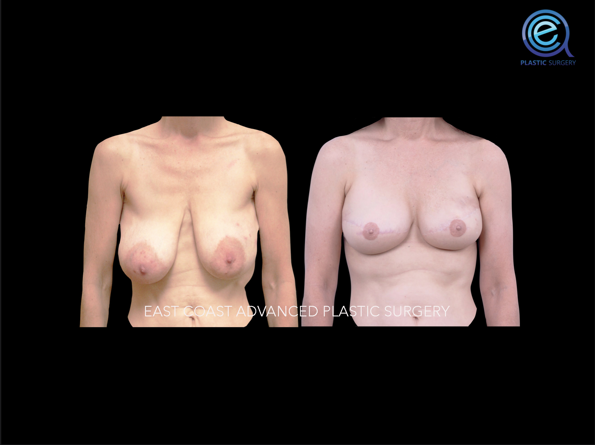 Latissmus Dorsi Flap Reconstruction