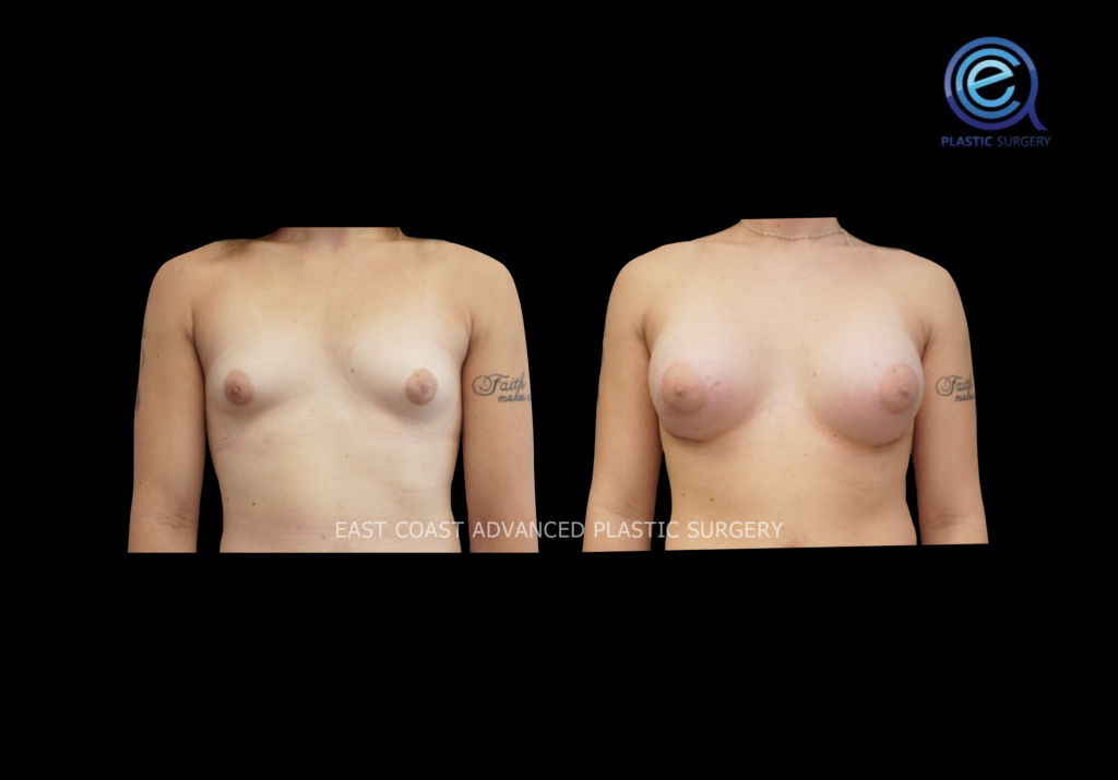 Chest Feminization