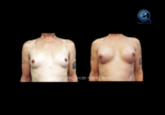 Chest Feminization