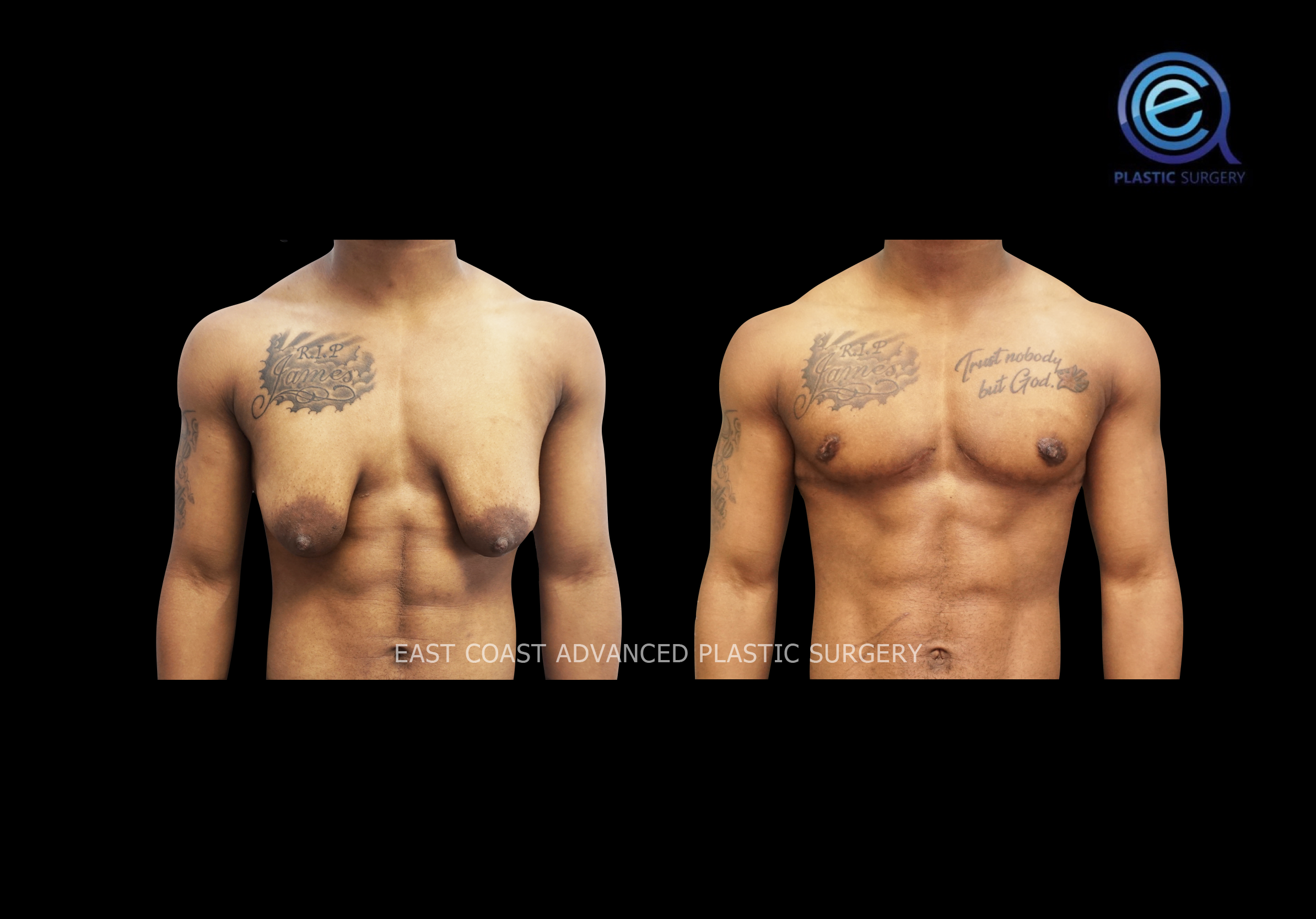 Chest Masculization - FTM Transmasculine Procedures