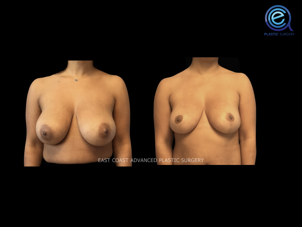 Breast Reduction Procedure