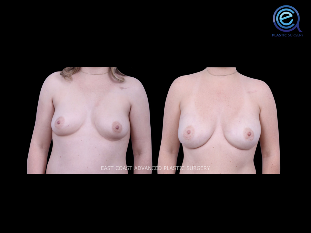 Bilateral Nipple Sparing Implant Based Reconstruction