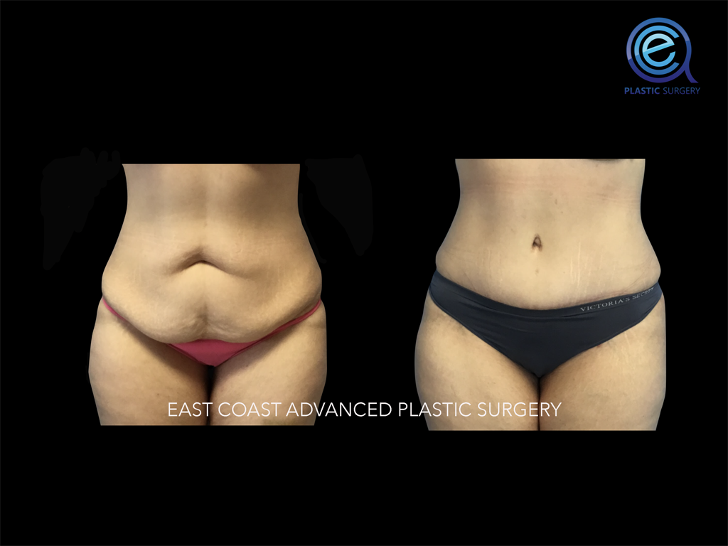 Abdominoplasty 