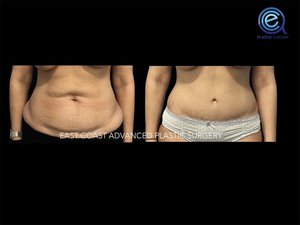 Abdominoplasty 