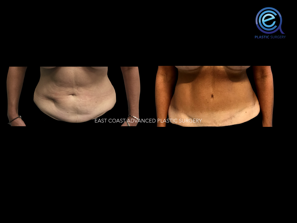 Abdominoplasty 