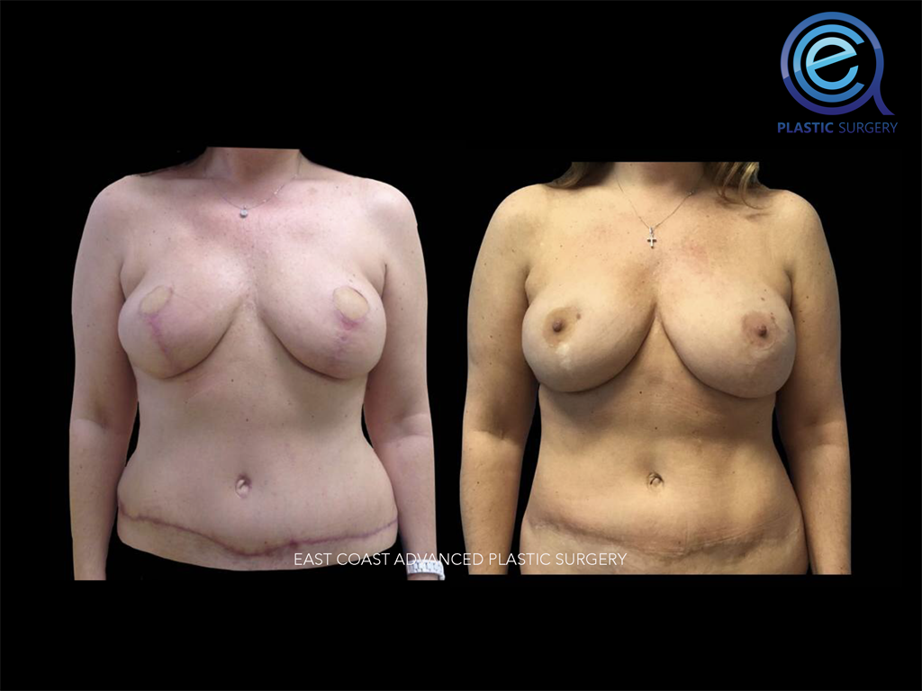 Fat Grafting After Breast Reconstruction