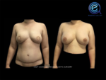 Fat Grafting After Breast Reconstruction