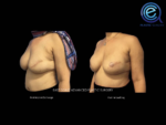 Fat Grafting After Breast Reconstruction