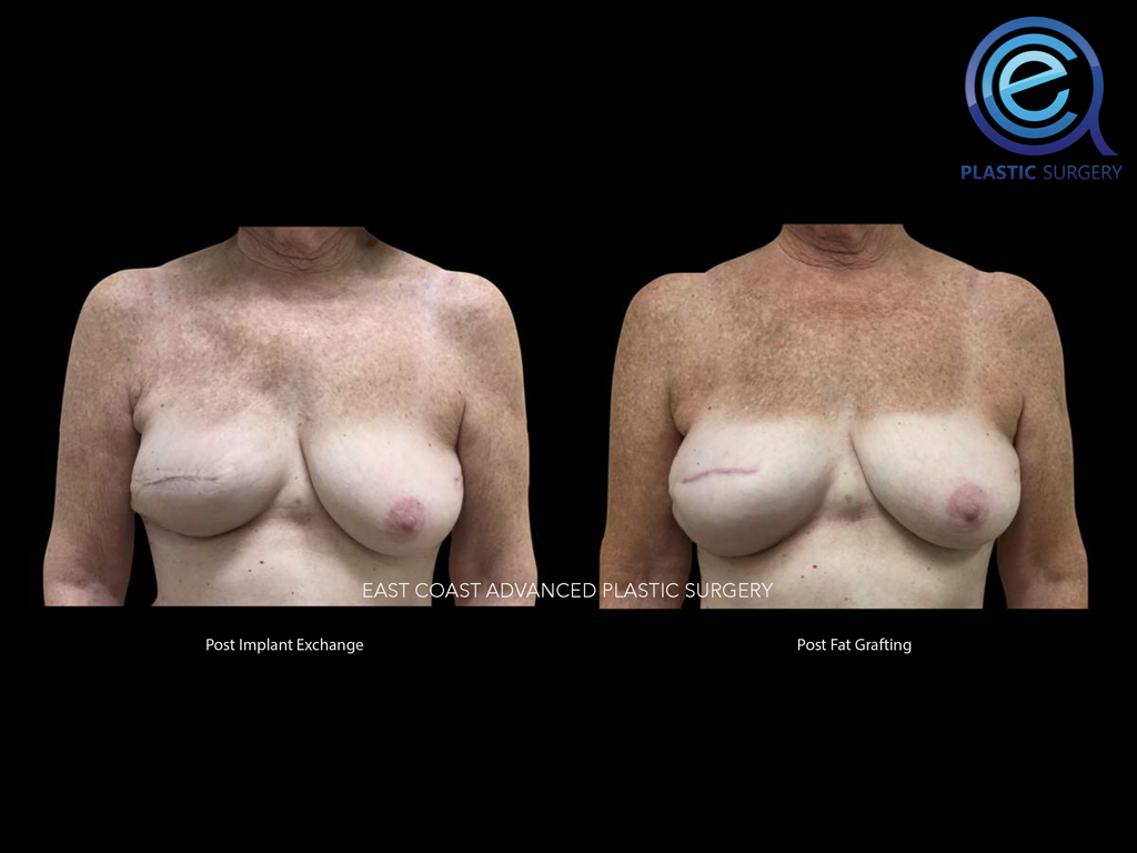 Fat Grafting After Breast Reconstruction