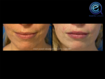 Lip Augmentation