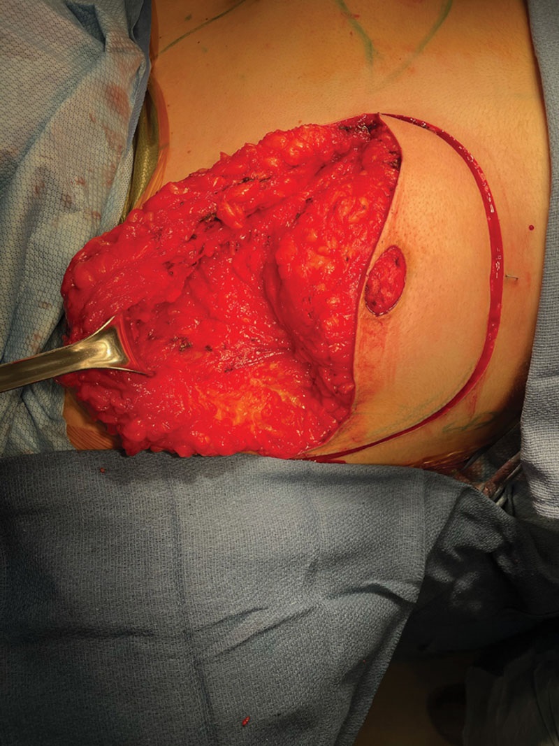 Elevation of superior flap up to clavicle
