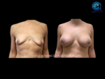 Breast Augmentation