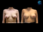 Bilateral Nipple Sparing Implant Based Reconstruction