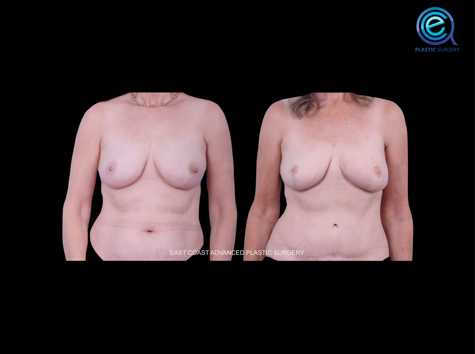 Unilateral Deep Inferior Epigastric Perforator Flap Reconstruction (DIEP)