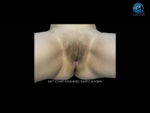 Vaginoplasty