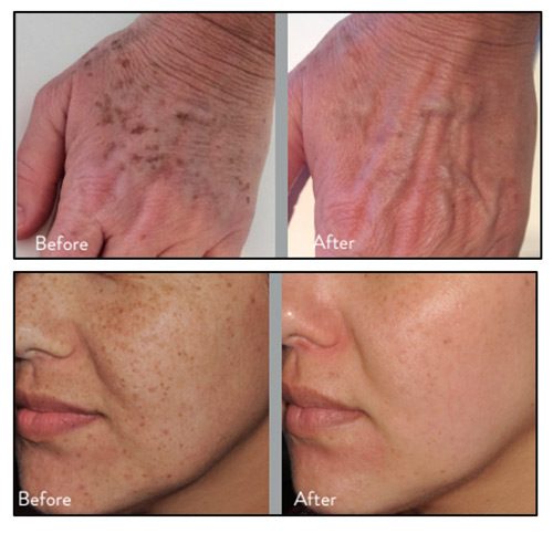 Lumecca Before and After Photos