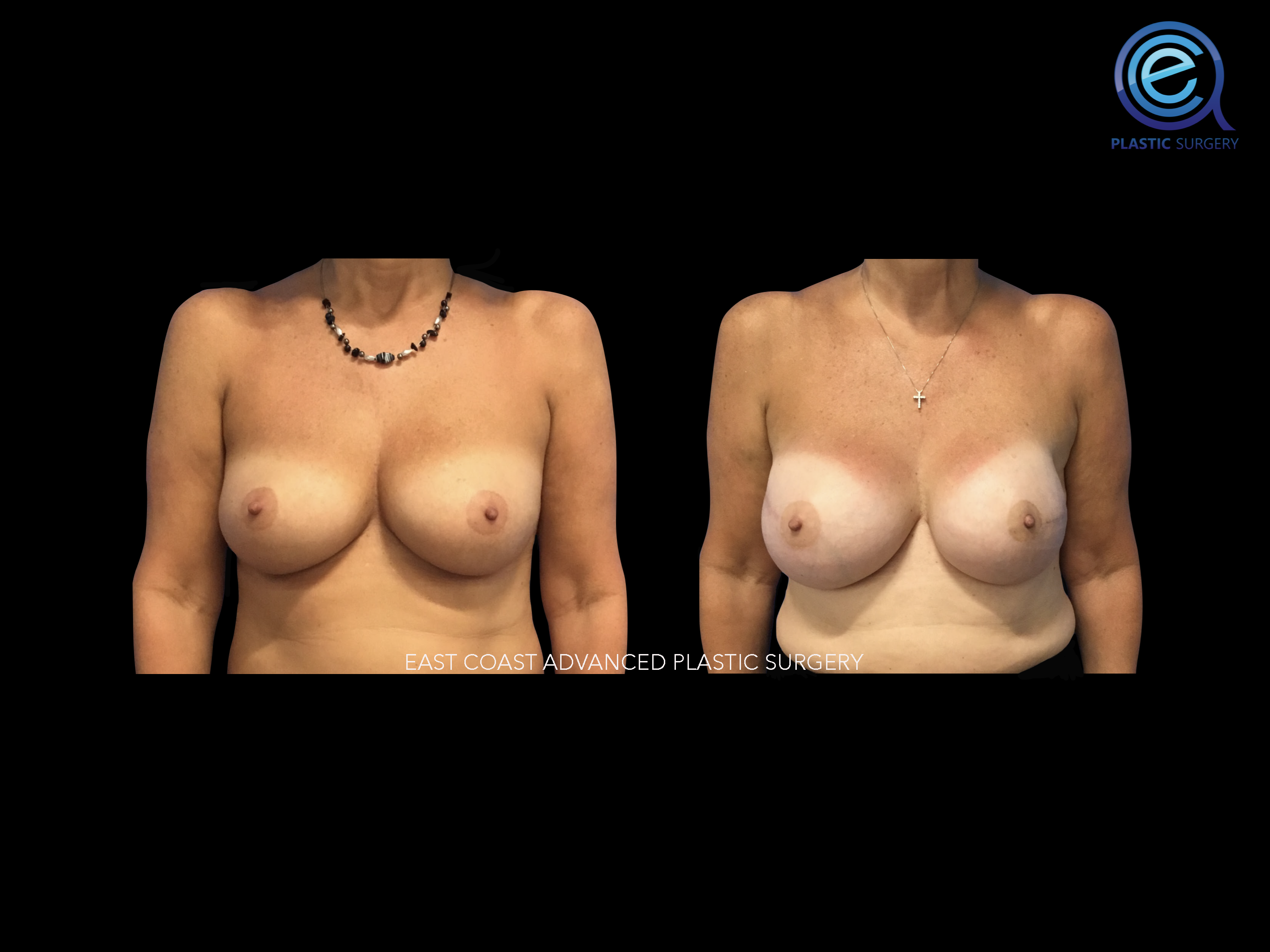 Bilateral Nipple Sparing Implant Based Reconstruction