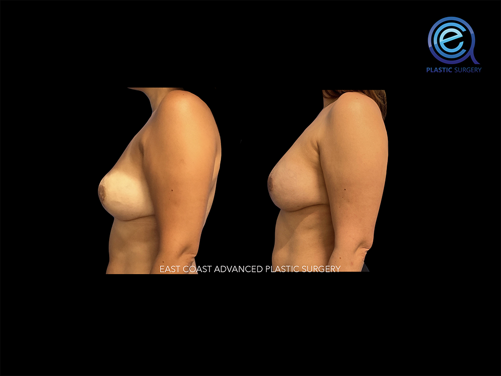 Fat Grafting After Breast Reconstruction