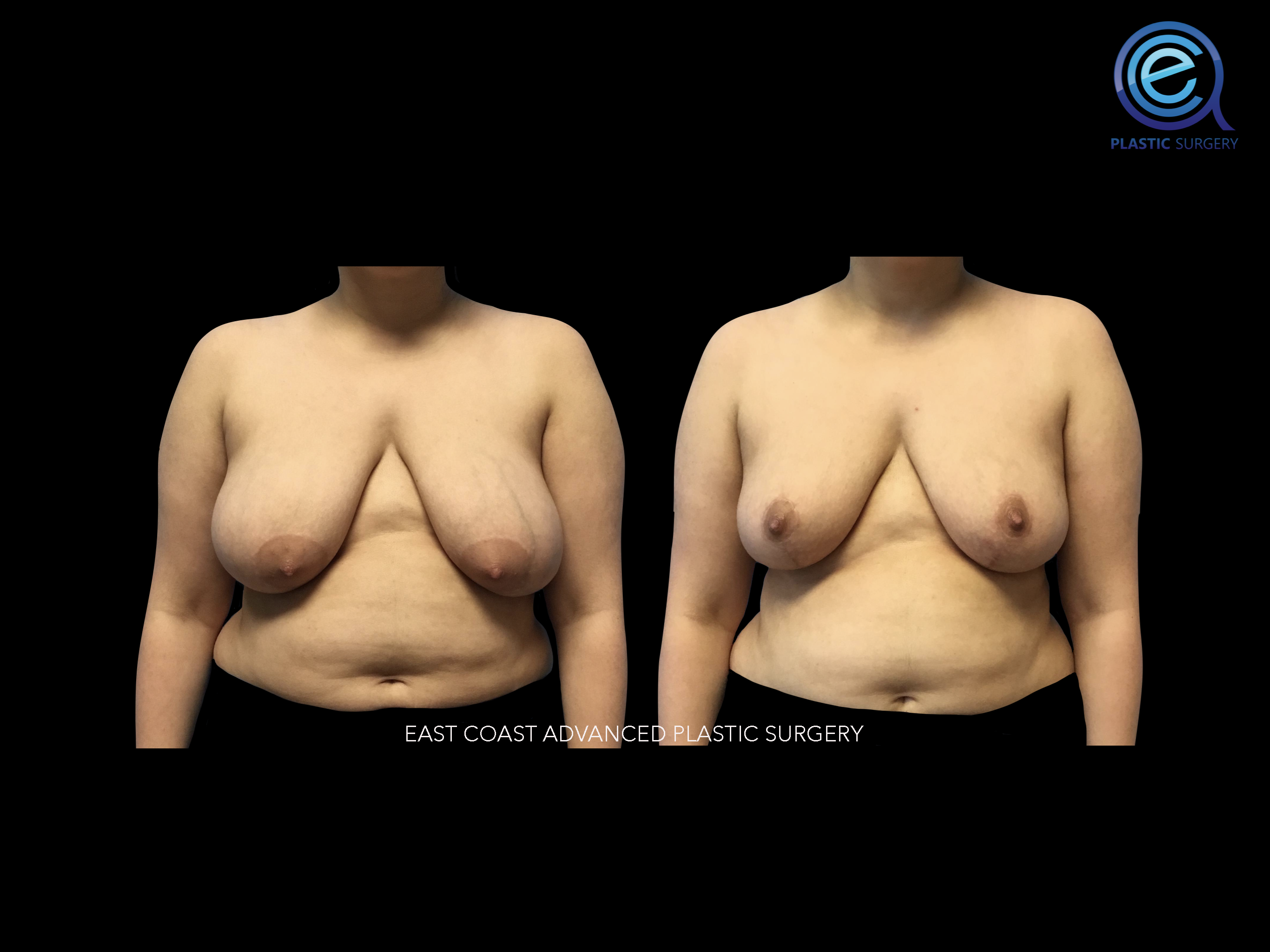 Oncoplastic Breast Reconstruction