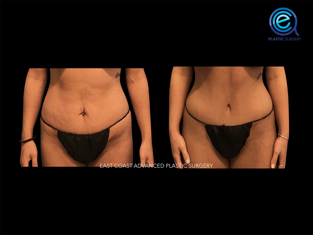 Abdominoplasty 