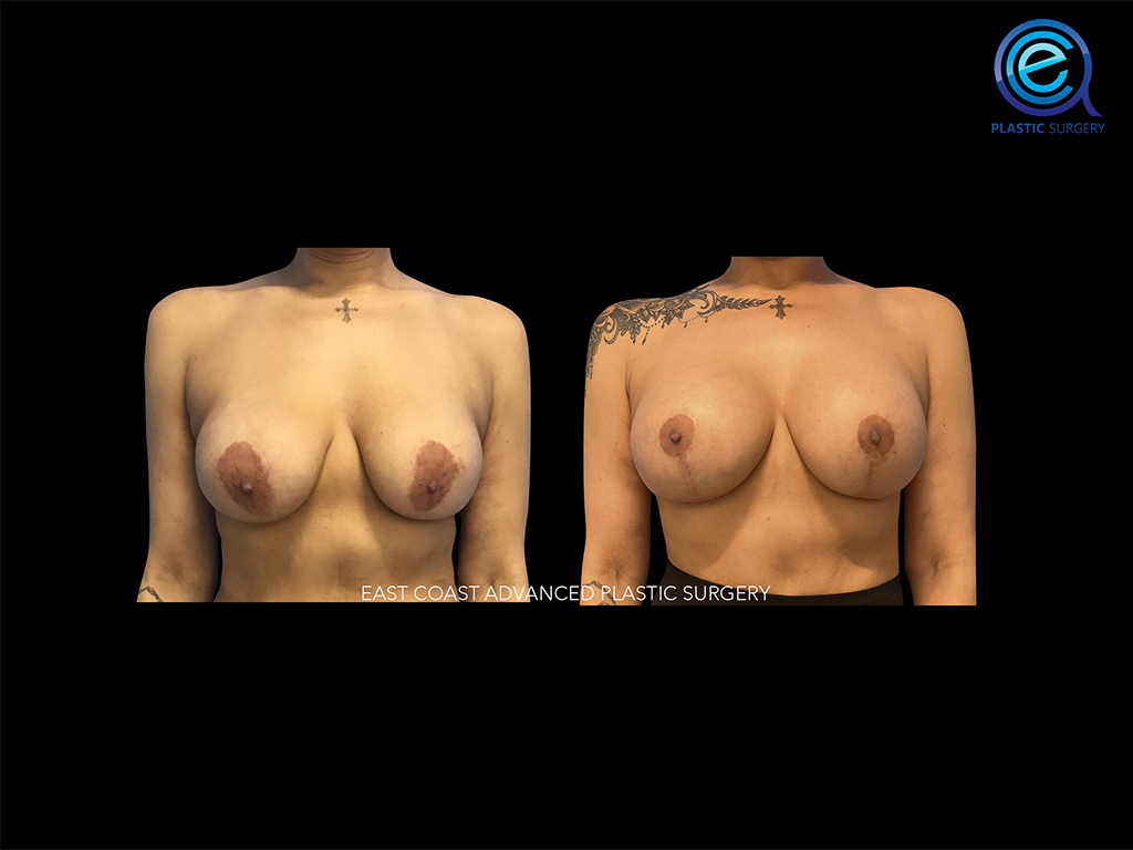 Breast Augmentation