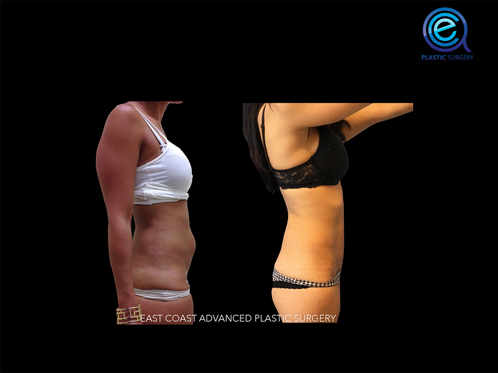 Abdominoplasty 