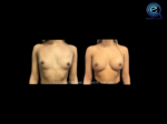 Bilateral Nipple Sparing Implant Based Reconstruction