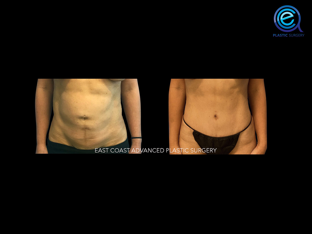 Abdominoplasty 