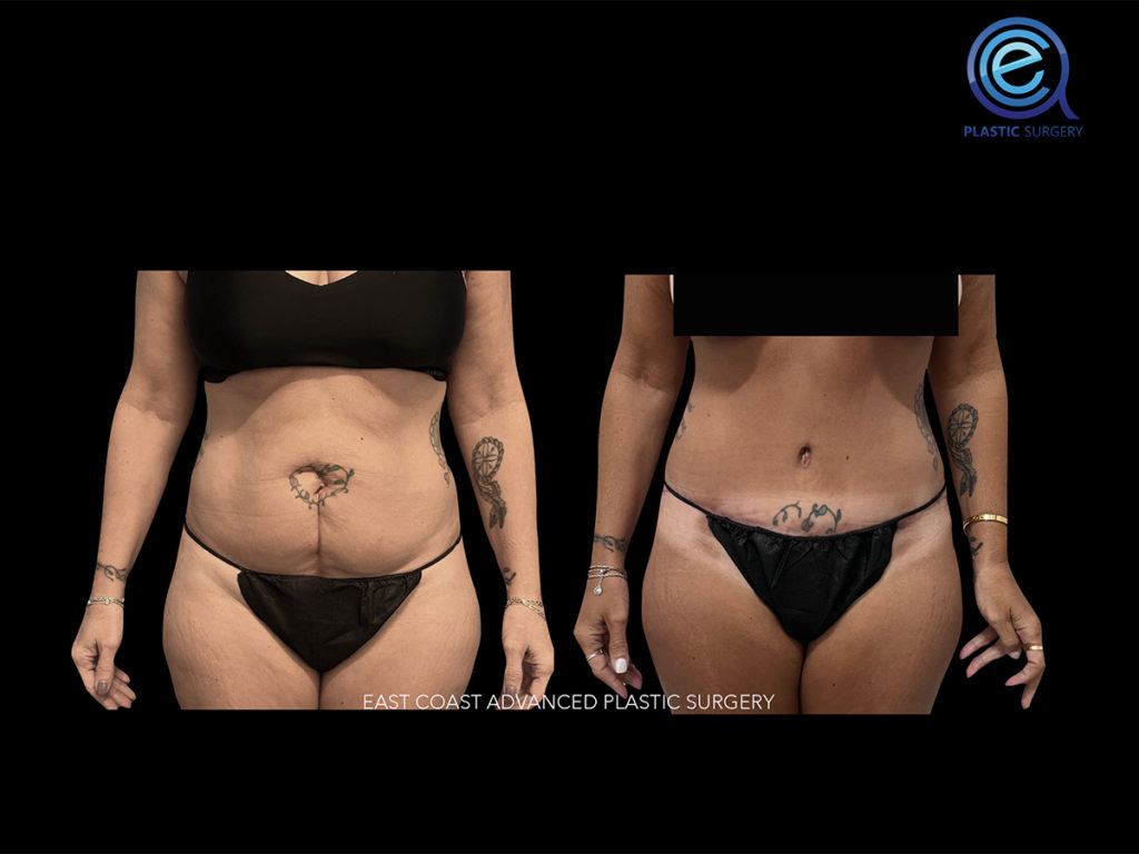 Abdominoplasty 