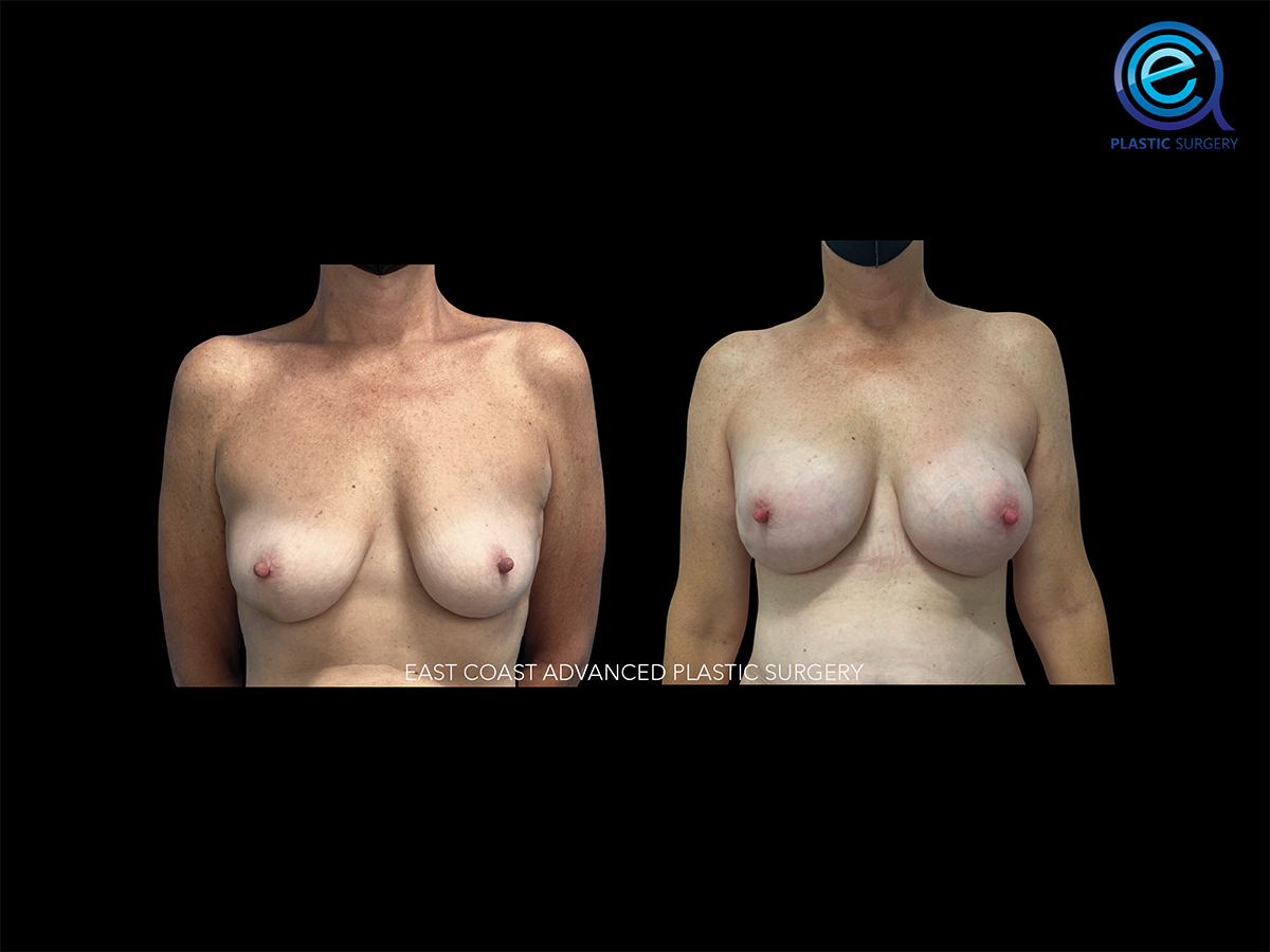 Bilateral Nipple Sparing Implant Based Reconstruction