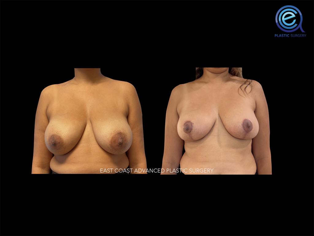 Breast Reduction