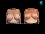 Oncoplastic Breast Reconstruction