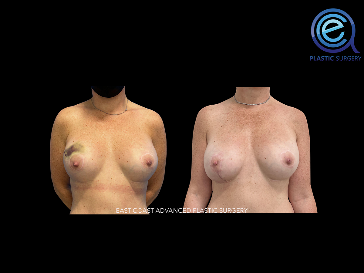 Unilateral Implant Based Reconstruction
