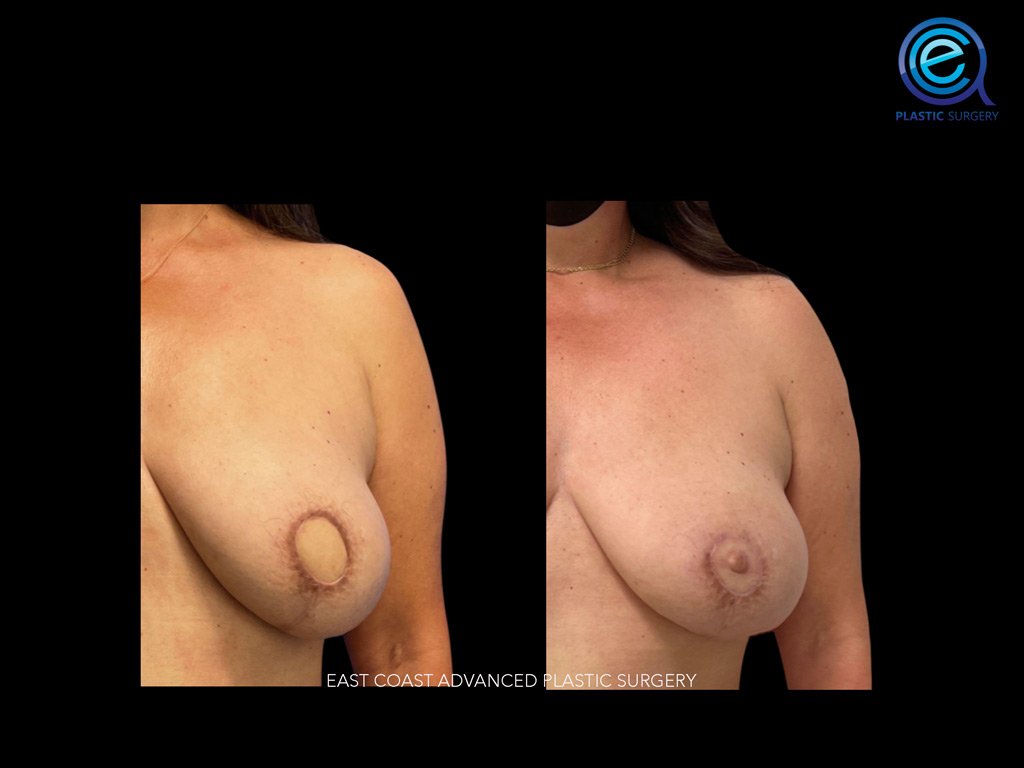 Nipple Reconstruction After Breast Reconstruction