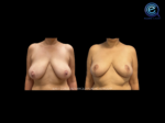 Breast Reduction