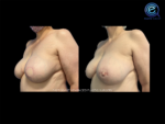 Nipple Reconstruction After Breast Reconstruction