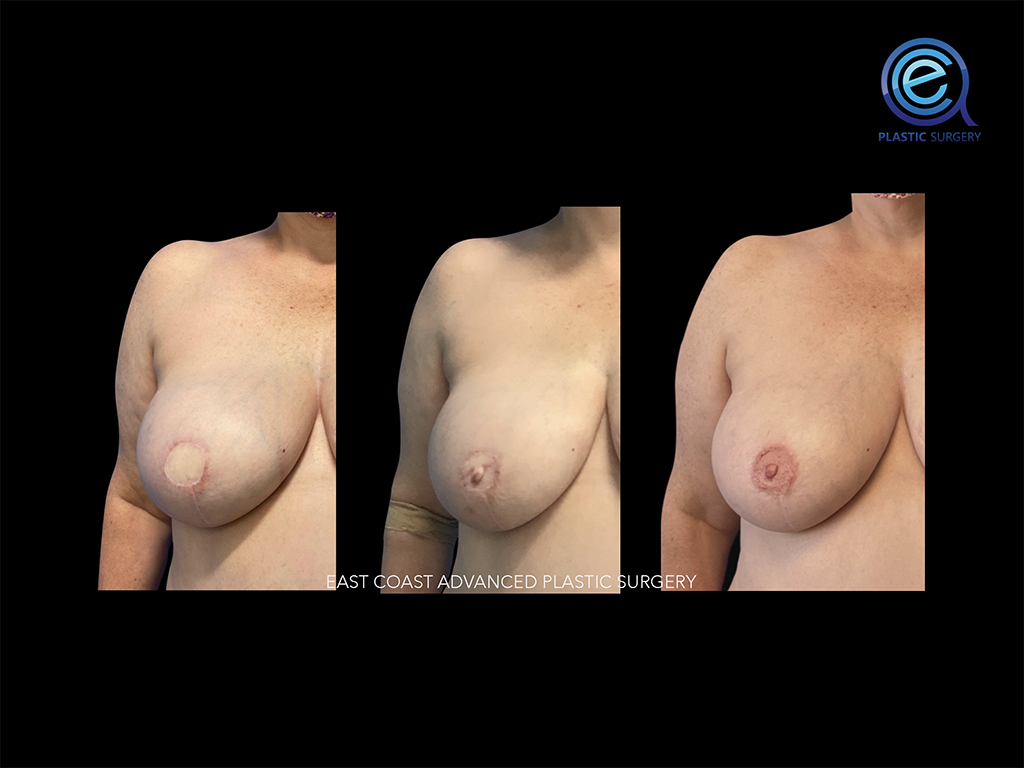 Nipple Reconstruction After Breast Reconstruction