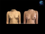 Breast Augmentation