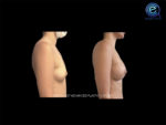 Breast Augmentation