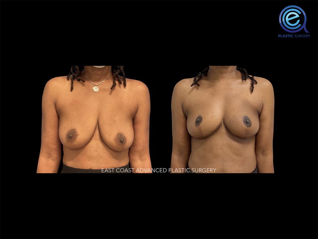 Oncoplastic Breast Reconstruction