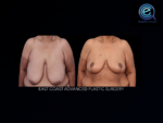 Oncoplastic Breast Reconstruction