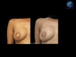 Nipple Reconstruction After Breast Reconstruction