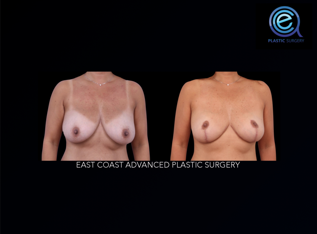 Oncoplastic Breast Reconstruction