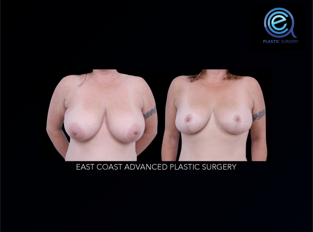 Oncoplastic Breast Reconstruction