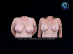 Oncoplastic Breast Reconstruction