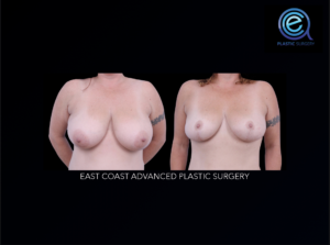 Oncoplastic Breast Reconstruction before and after photo by East Coast Advanced Plastic Surgery (ECAPS), in New York, NY
