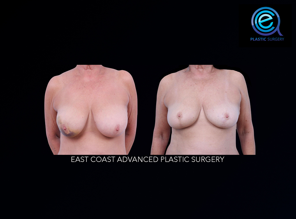 Oncoplastic Breast Reconstruction