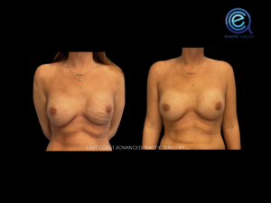 Fat Grafting After Breast Reconstruction before and after photo by East Coast Advanced Plastic Surgery (ECAPS), in New York, NY